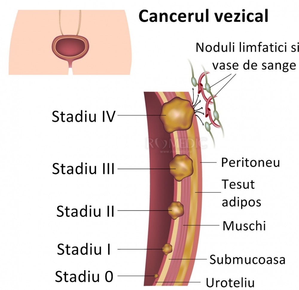 Cancerul de vezica urinara (vezical): Cauze, diagnostic, tratament | casadeculturacluj.ro