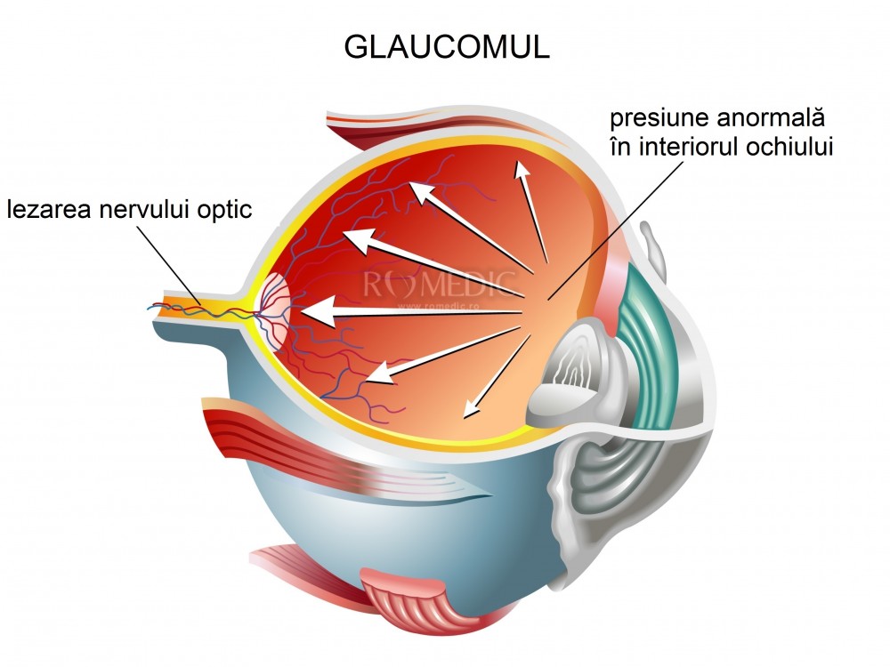 cum să îmbunătățim glaucomul vizual)